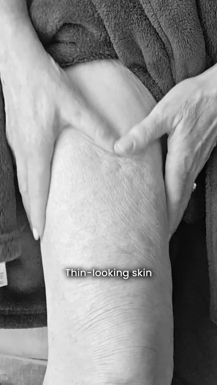 Thin Skin Isn’t Always About Age