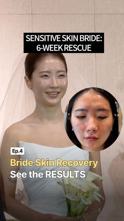 6 weeks to get her skin wedding-ready💍

One of our Demaf teammates had been dealing with seborrheic dermatitis and rosacea for 5 years. Regina’s plan was never about an overnight fix, just small, steady changes leading up to her big day.

Round 1: Strip everything back to basics
Round 2: Start over after a flare-up
Round 3: The final stretch — sunscreen, patience, and trusting the process

By week 6, even she couldn’t believe the difference. And Regina, who had been secretly worried it might not work, could finally relax 😂

Regina’s last advice before the wedding?
Skincare first, sunscreen always.

On her wedding day, her skin made it through hours of bridal makeup and was still dewy, still glowing ✨

Congratulations, dearie. This one means a lot to us too 🤍

We’ll always be here for the skin journeys that take time, patience, and sometimes more than one try.

One project down. Who’s next? Stay tuned 👀
