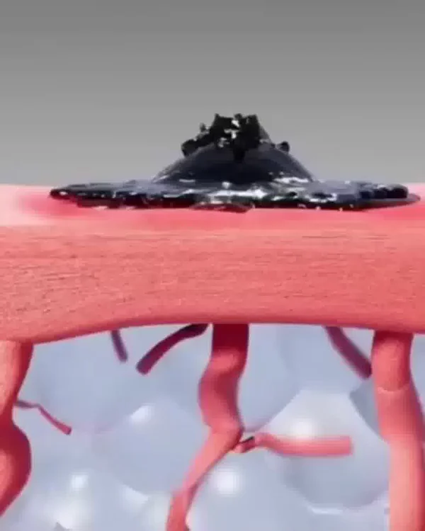 This wart bothered me for years - now it's gone (without a doctor!)