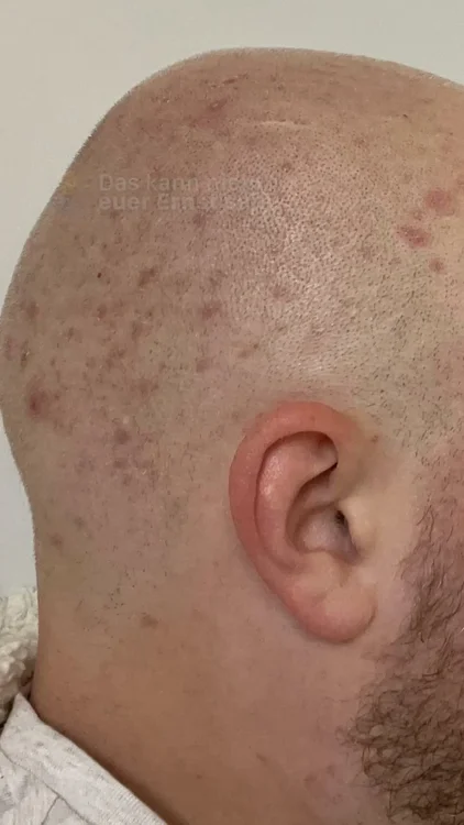 🧑‍🦲 Perfekte Glatze in 90 Sekunden.