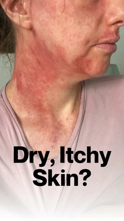 Living with eczema?