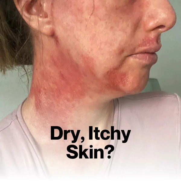 Natural Treatment for Skin Flare-Ups